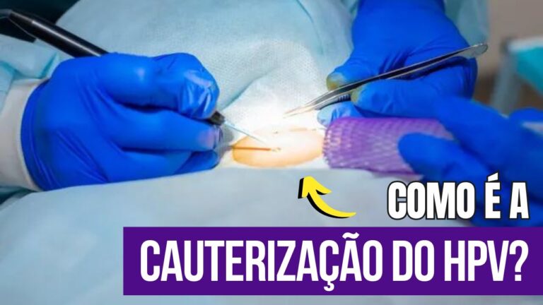 Cauteriza&ccedil;&atilde;o de Verrugas HPV: Efic&aacute;cia e Procedimentos