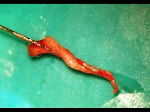 Inflamação no Canal do Dente: Causas e Tratamentos Eficazes