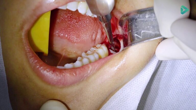 Remoção Eficiente de Dentes Semi Inclusos e Impactados