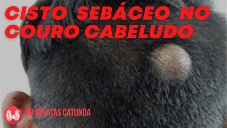CID 10: Cisto Sebáceo Desvendado