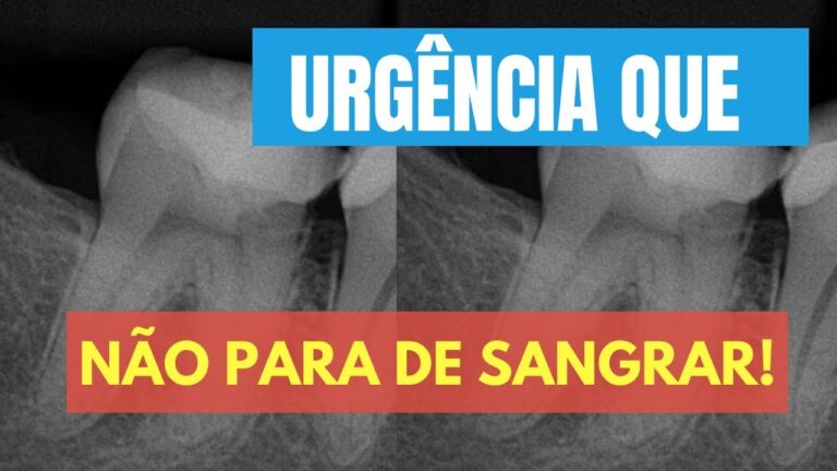 Dente Furado e Sangrando: Como Proceder?