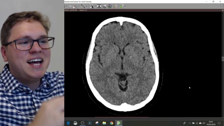 Tomografia de Crânio: Entendendo Alterações e Diagnósticos