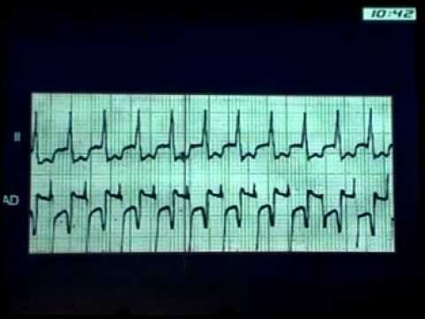 Entendendo a Arritmia Supraventricular