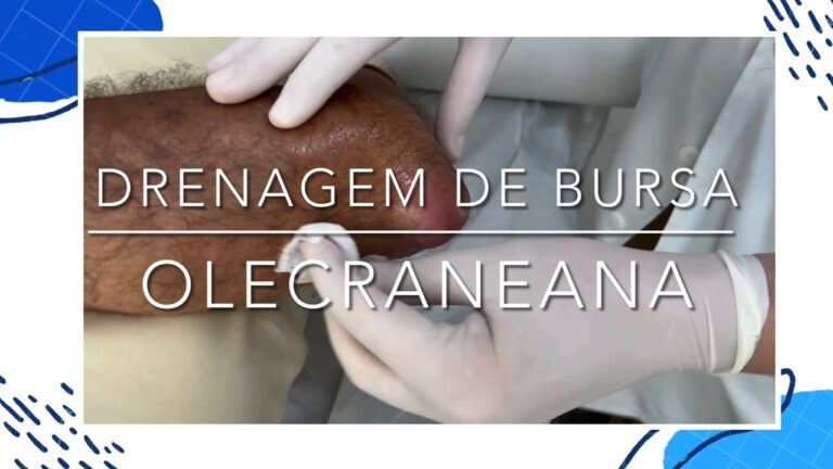 Drenagem Eficaz para Bursite no Cotovelo