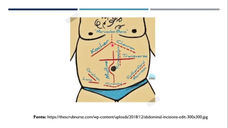 Incisões Abdominais: Técnicas e Cuidados Essenciais