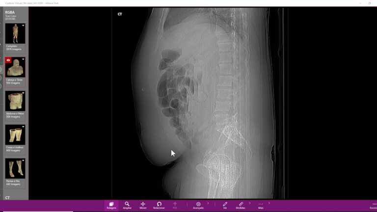 Trombose Intestinal: Imagens e Informa&ccedil;&otilde;es Essenciais