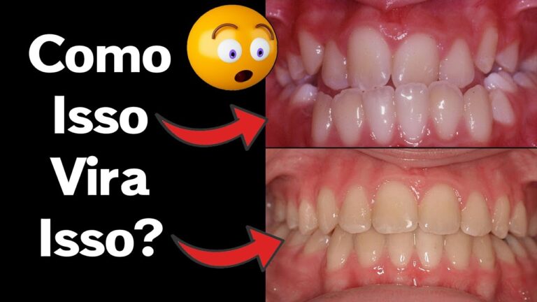 Entendendo o Funcionamento dos Aparelhos Dentários