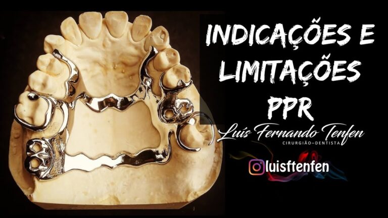 Benefícios da Prótese Parcial Removível para um Dente