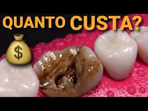 Custo de Uma Obturação: Tudo o que Você Precisa Saber