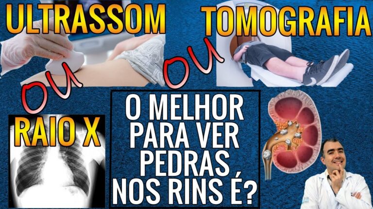 Diagnóstico de Pedra no Rim por Raio X: O que Você Precisa Saber