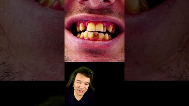 Causas dos Dentes de Leite Quebradiços