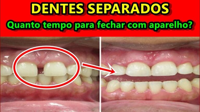 Tempo para Correção de Dentes para Frente com Aparelho