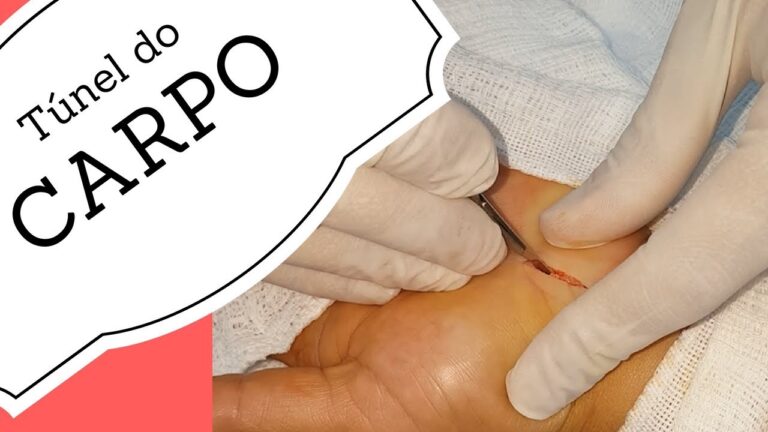 Entenda Como É Feita a Cirurgia do Túnel do Carpo