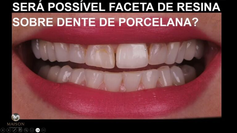 Facetas de Porcelana: O Que São e Como Funcionam
