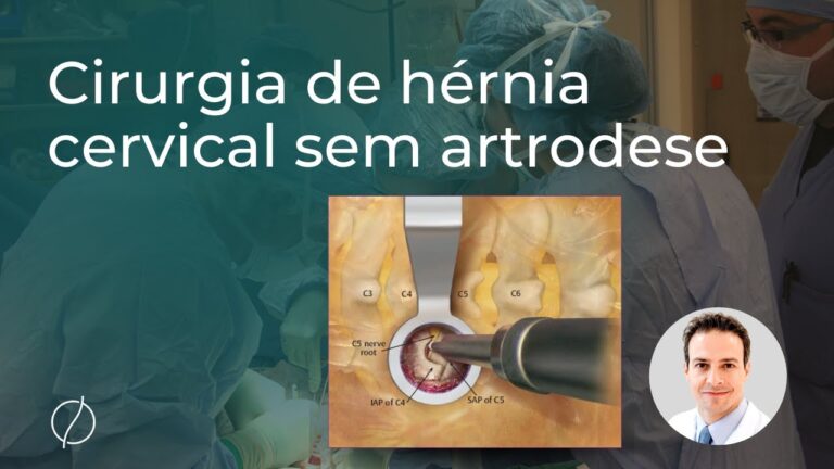 Cirurgia de H&eacute;rnia Cervical: O que Voc&ecirc; Precisa Saber