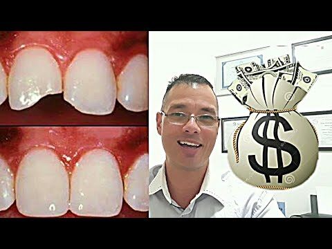 Custo de Obtura&ccedil;&atilde;o em Dente Frontal