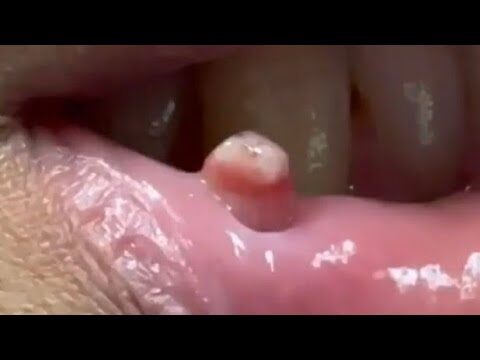 Fibroma na Boca: Identificação e Exemplos Visuais