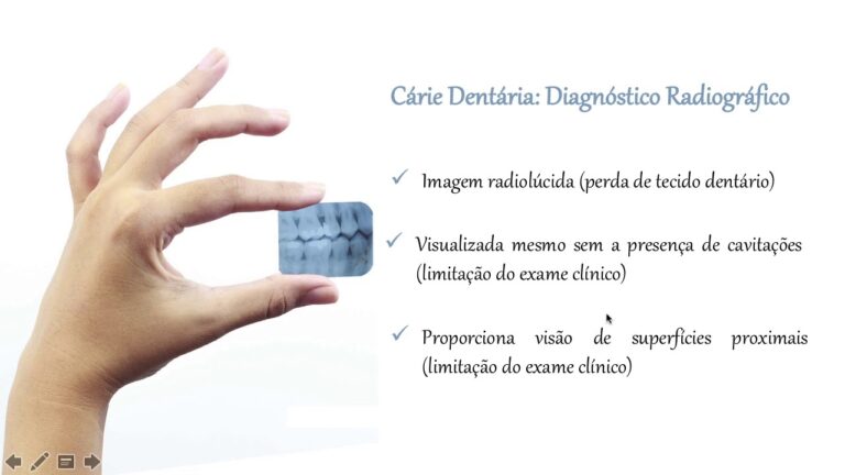 Detecção de Cáries em Radiografias: Técnicas e Importância