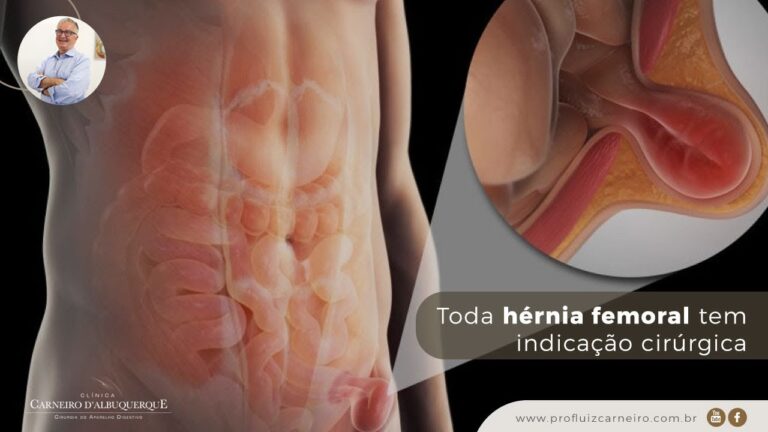 Hérnia Femoral Masculina: Causas, Sintomas e Tratamentos