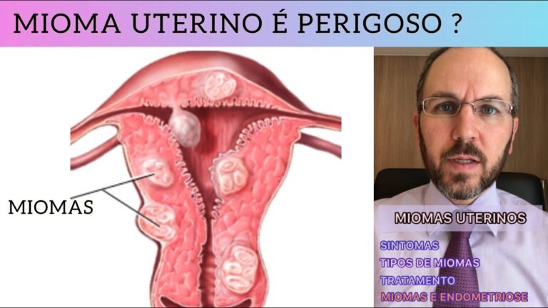 Tratamentos Eficazes para Mioma Figo 5