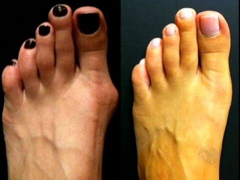Cirurgia para Reduzir o Pé: Benefícios e Considerações