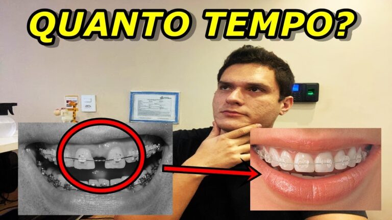 O Tempo Necessário para o Movimento Dental