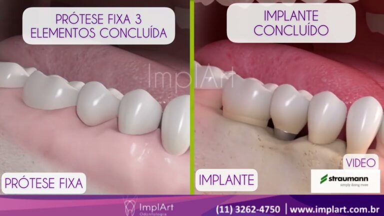Diferença entre Prótese e Implante Dentário: Entenda as Opções