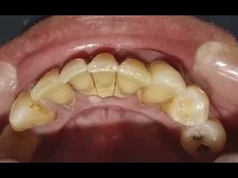 Limpeza de Dentes com Ultrassom: Benefícios e Eficácia