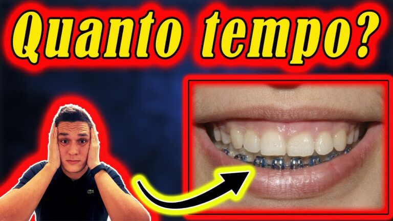 Quanto Tempo Leva para Colocar Aparelho Dental?