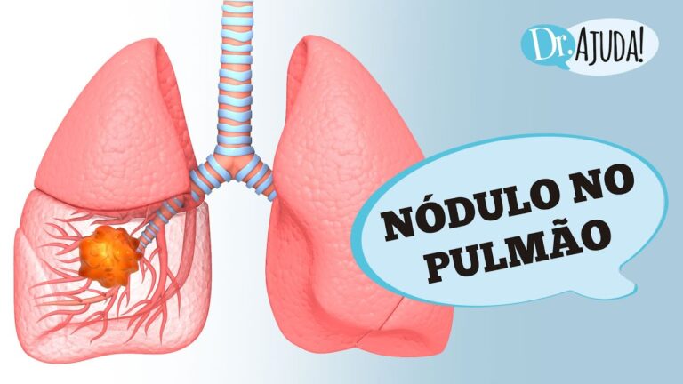 Nodulo Pulmonar: Possibilidade de Desaparecimento