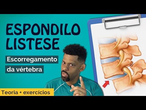 Espondilolistese Grau 1: Causas, Sintomas e Tratamento