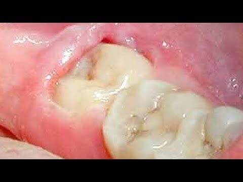 Custo do Procedimento de Extração do Dente Siso