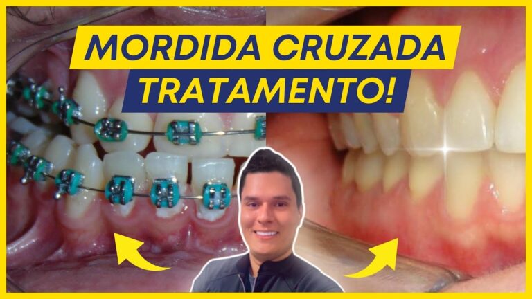 Como Corrigir a Mordida Torta?