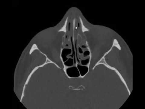 Perfuracao do Septo Nasal: Causas, Sintomas e Tratamentos