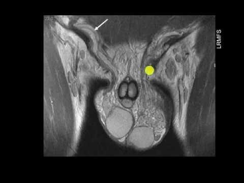 Como Identificar a Varicocele: Sinais e Sintomas
