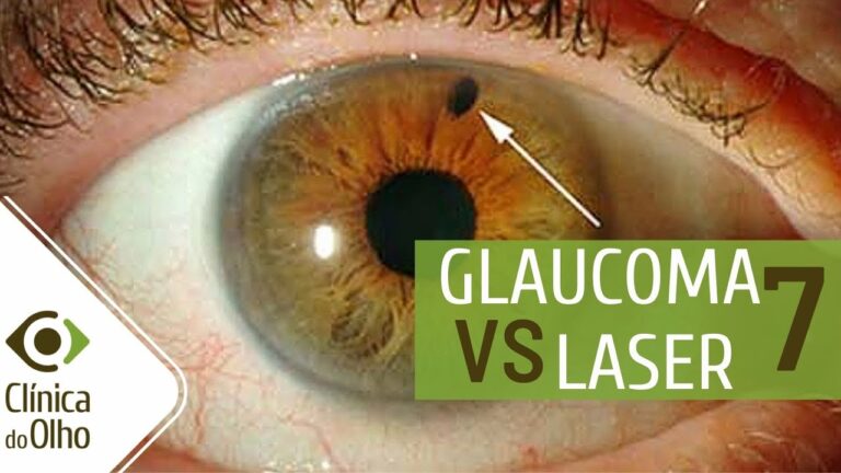Iridectomia a Laser: Benef&iacute;cios e Indica&ccedil;&otilde;es