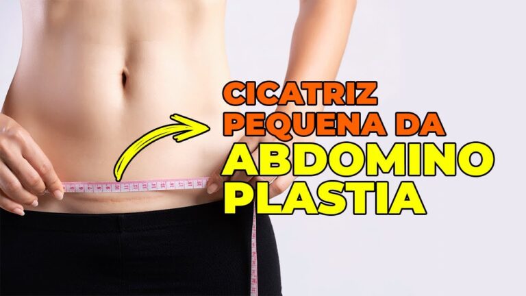 Mini Abdominoplastia: Cicatriz Discreta e Resultados Naturais
