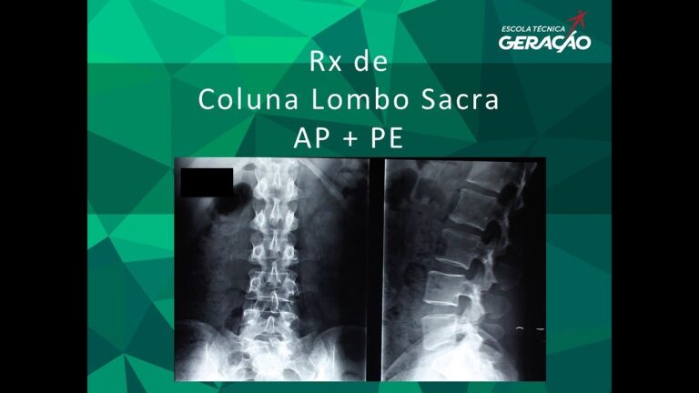 Tratamento Eficaz para Rx Lombo Sacral: O Guia Completo