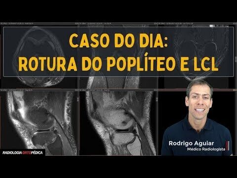 Entendendo o Tendão Poplíteo: Funções e Cuidados