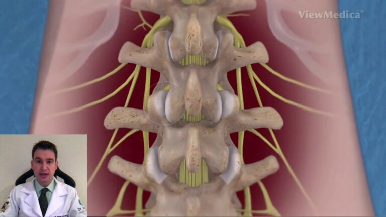 Cirurgia de Artrose na Coluna: Soluções e Avanços