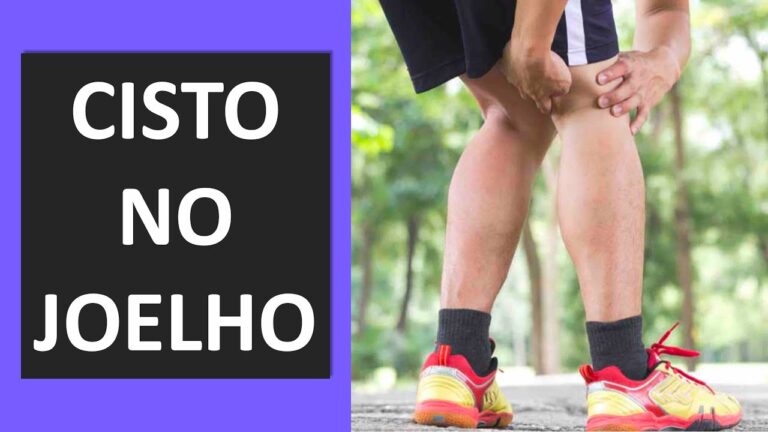 Entendendo o Cisto Gangliônico no Joelho: Causas e Tratamentos