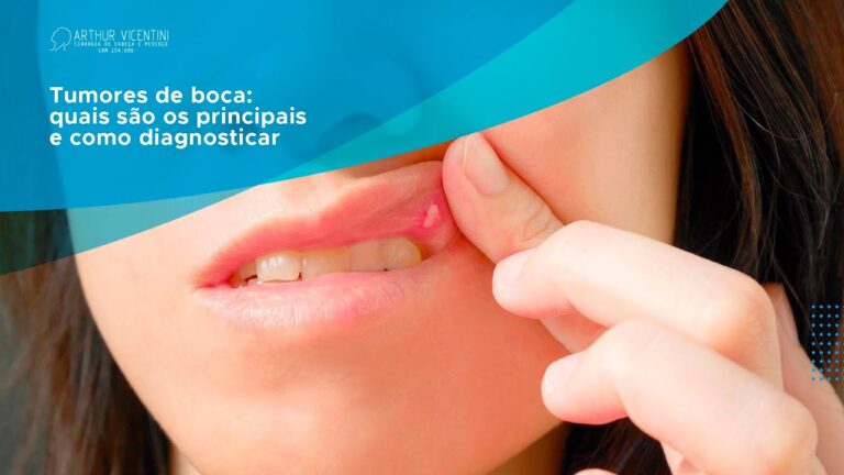 Tratamento Eficaz para Cid Afta Bucal