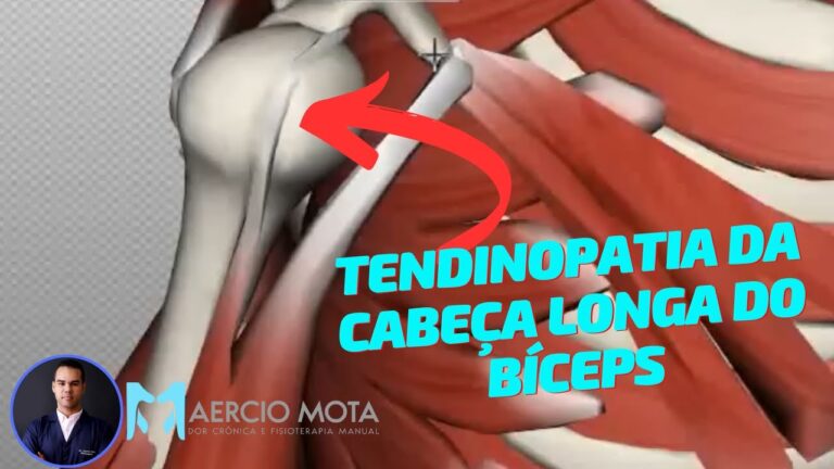 Tratamento Eficaz para Tendinite da Cabe&ccedil;a Longa do B&iacute;ceps