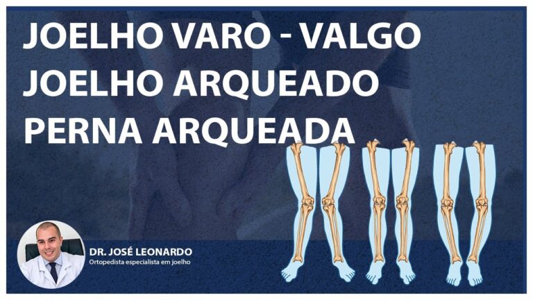 Custo da Cirurgia para Joelho Varo: O Que Esperar