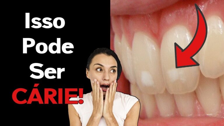 Causas e Soluções para Manchinhas Brancas nos Dentes