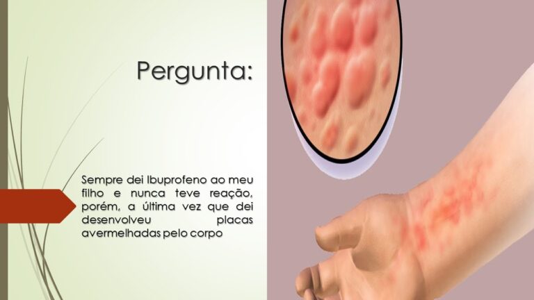 Entendendo a Alergia ao Ibuprofeno: Causas e Sintomas