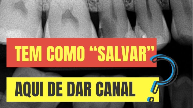 Tratamento para Dente com Cárie Profunda: O Que Fazer?