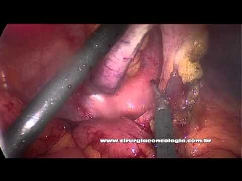 Vantagens da Cirurgia de Apendicite a Laser