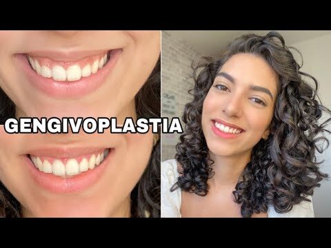 Gengivoplastia: Entenda a Importância e Procedimentos