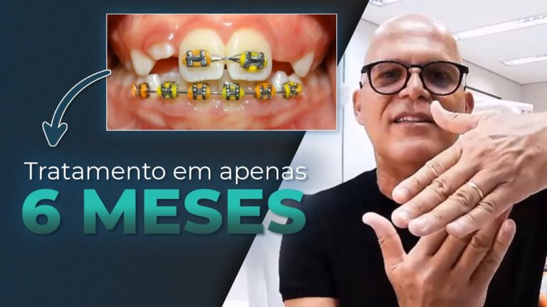 Benefícios do Aparelho Ortodôntico Infantil Fixo